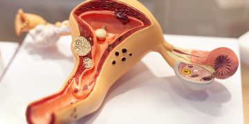 גידול ברחם טיפול נוסף שכדאי לשלב