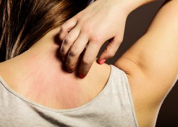 בעיות עור – פסוריאזיס