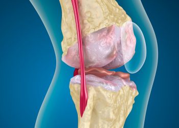 אוסטאופורוזיס